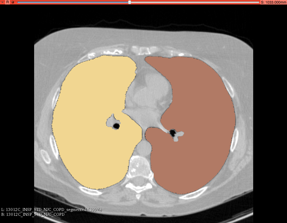 Lung segmentation