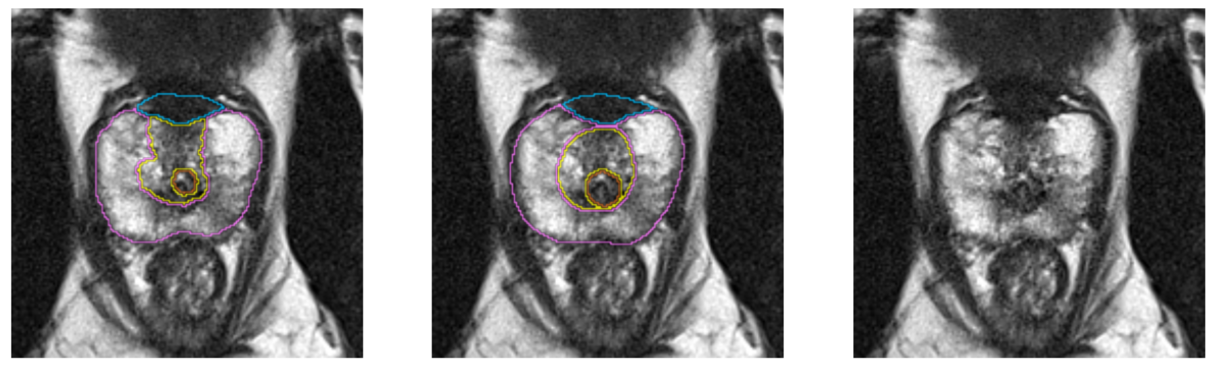 Segmentation Example. Left: automatic, center: manual segmentation