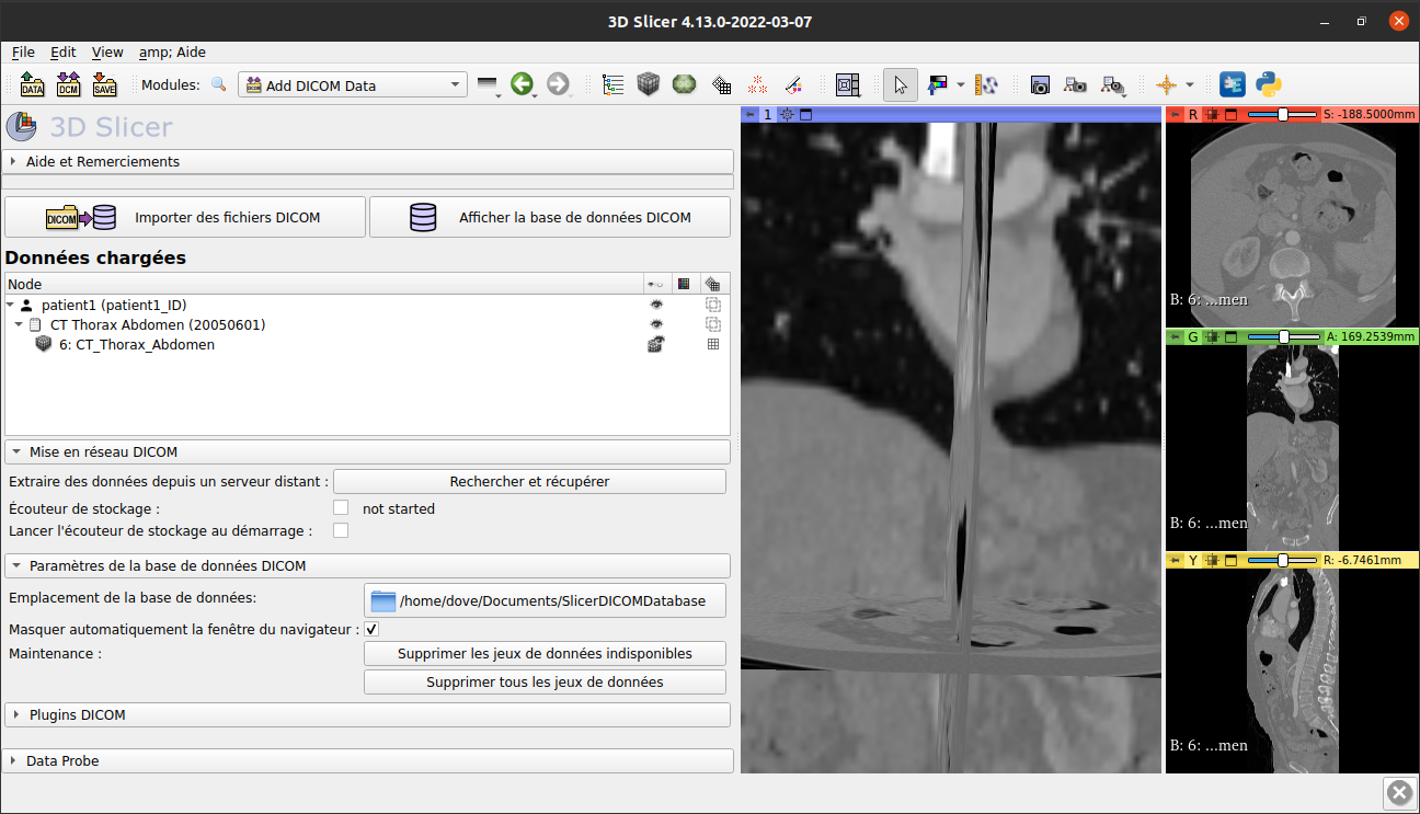 3D Slicer's DICOM module translated to french